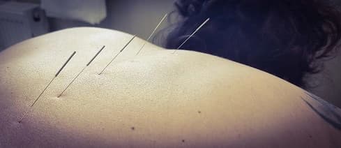 Βελονισμός